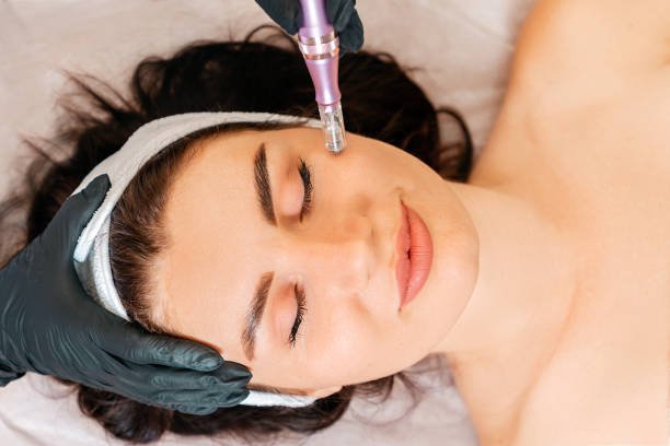 Microneedling Side Effects